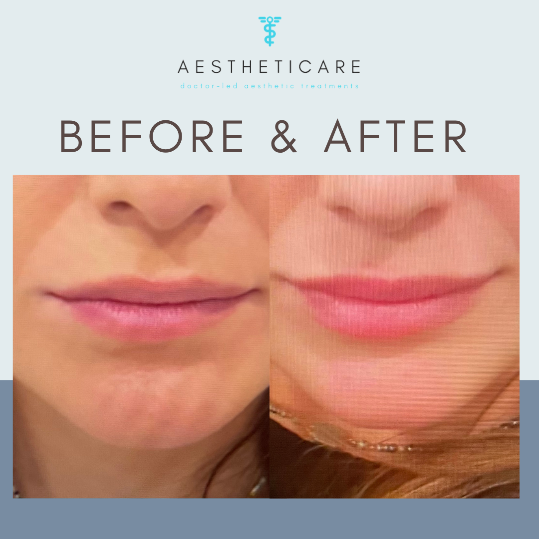 lip filler before and after, increase lip volume