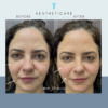 Cheek Fillers - Image 7