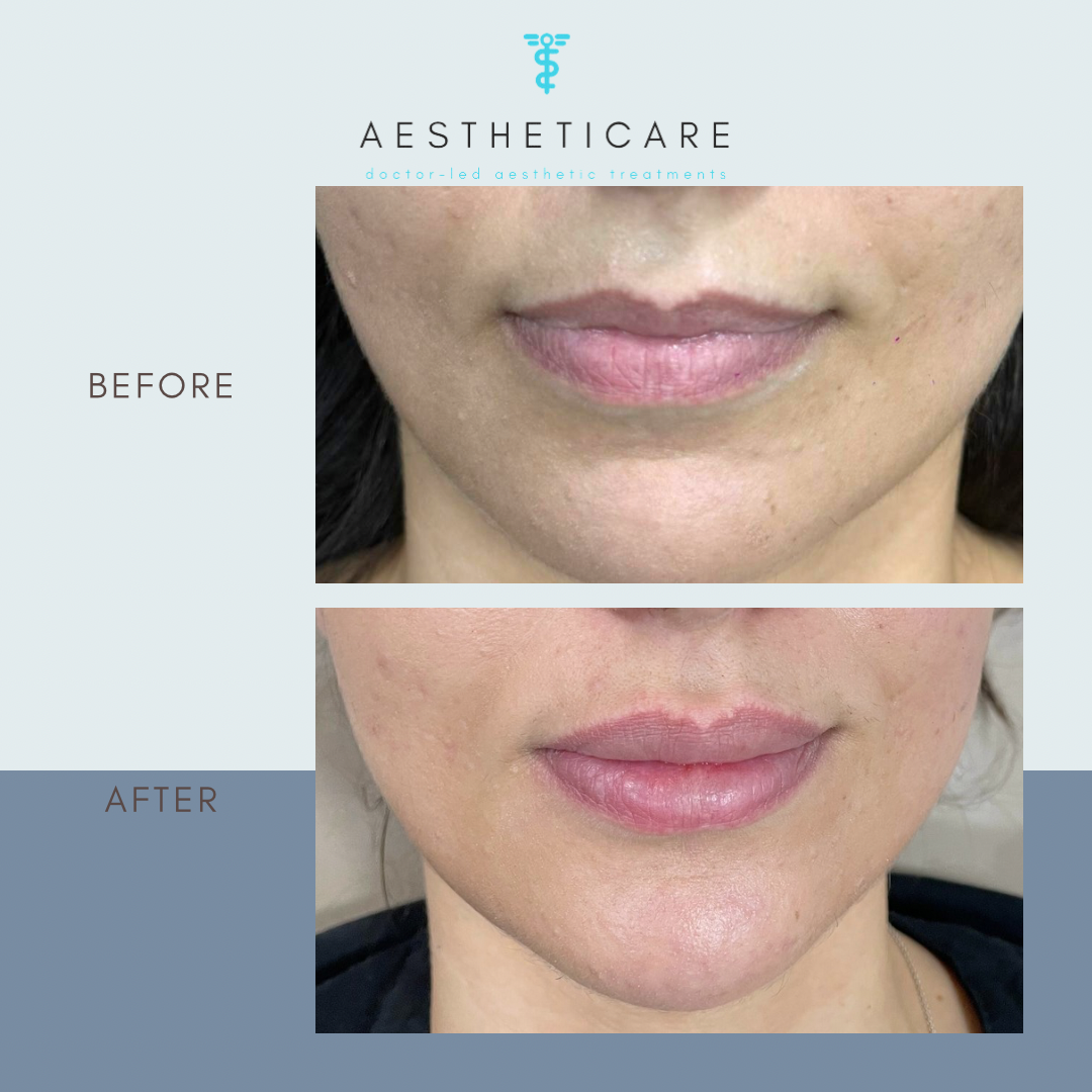 Copy of Aestheticare Before and After Progress Instagram Post - 18
