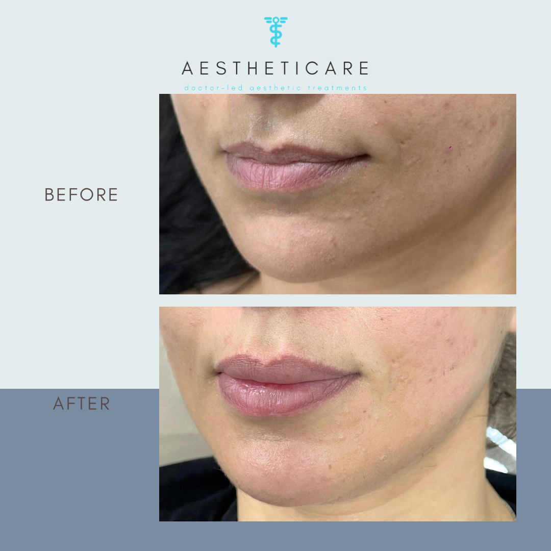 Copy of Aestheticare Before and After Progress Instagram Post - 19