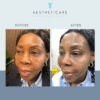 cheek filler, before and after, central london, doctor led results, barbican, farringdon
