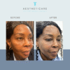 cheek filler before and after
