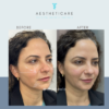 Cheek filler Before & After