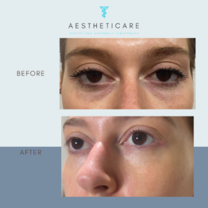 under eye polynucleotides for dark circles