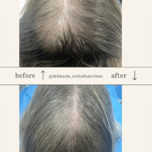 hair loss before and after