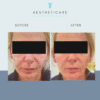 Cheek Fillers - Image 5