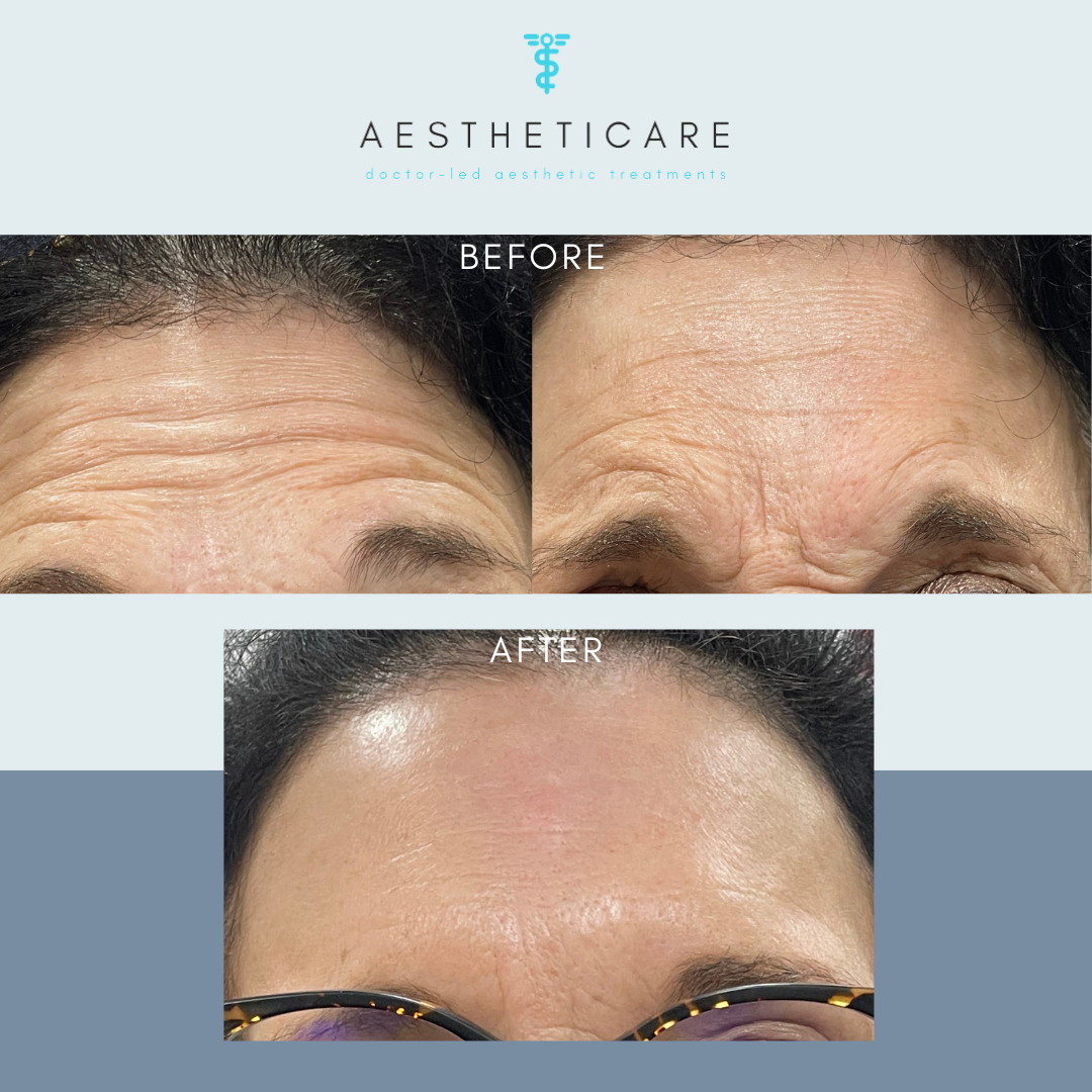 before and after anti wrinkle injections forehead
