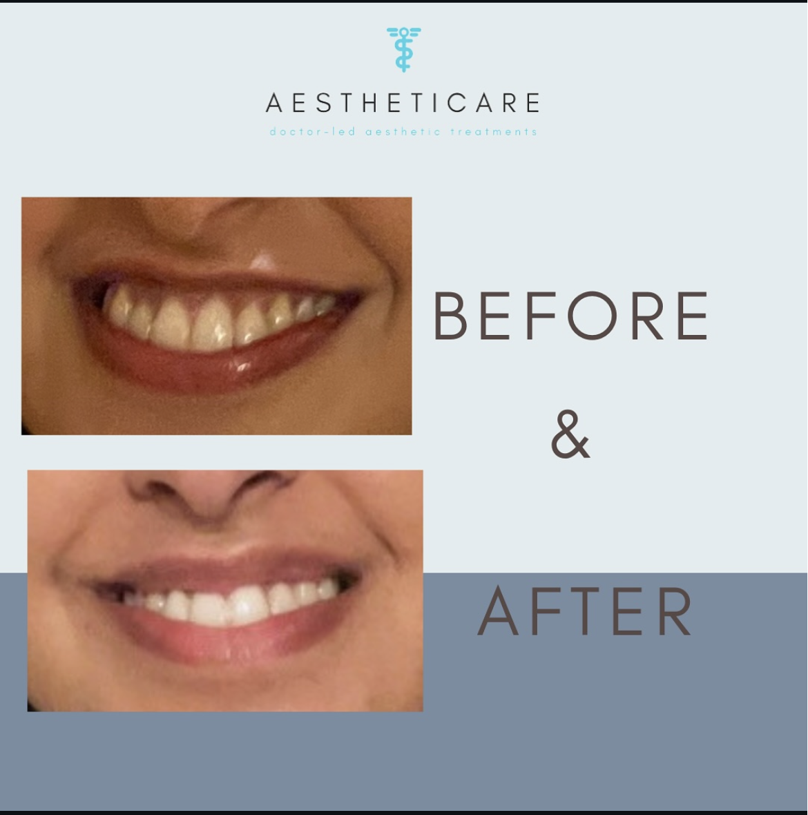 Lip Flip result Moorgate